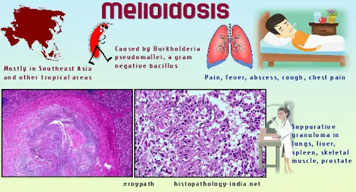 Fakta penyakit melioidosis