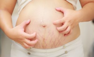perubahan kulit ketika hamil