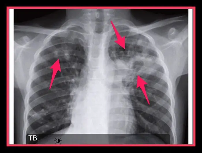 penyakit tb paru-paru