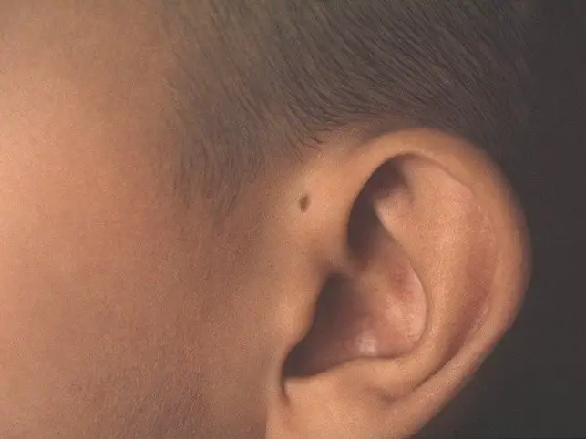 lubang extra di telinga
