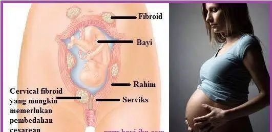 fakta fibroid