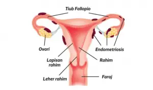 ketumbuhan endometriosis