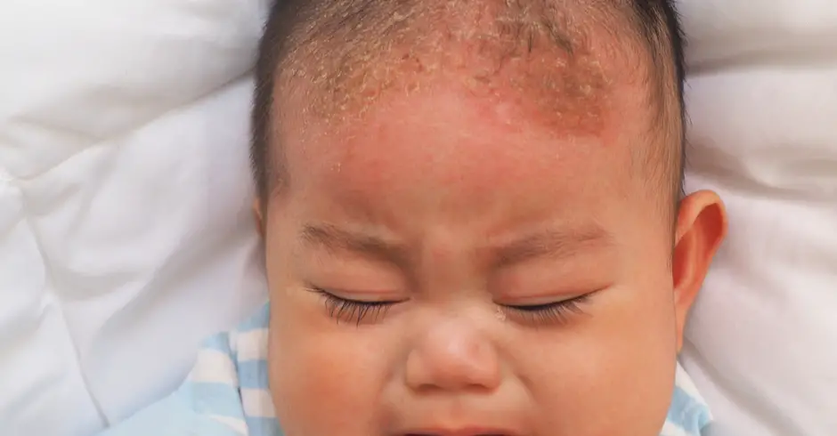 punca dan cara hilangkan kerak di kepala bayi