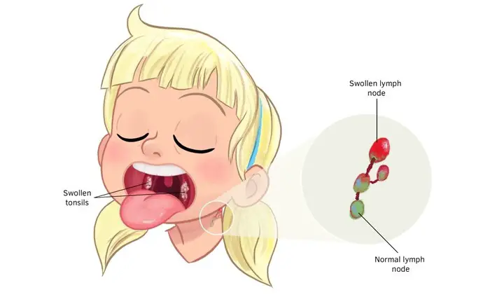 3 Tanda Anak Penghidap Tonsil Perlu Antibiotik (Jangan 