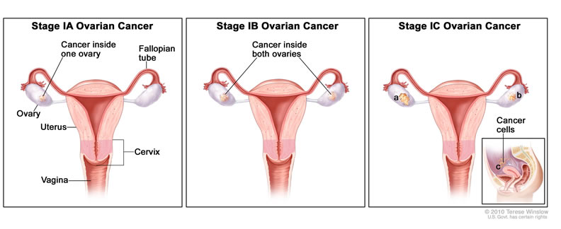 kanser rahim