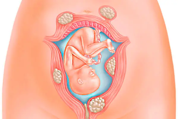Fibroid semasa mengandung