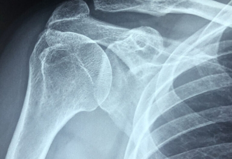 Apa Itu Frozen Shoulder Bahu Keras? Bidadari.My